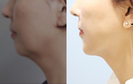 턱지방흡입/6개월