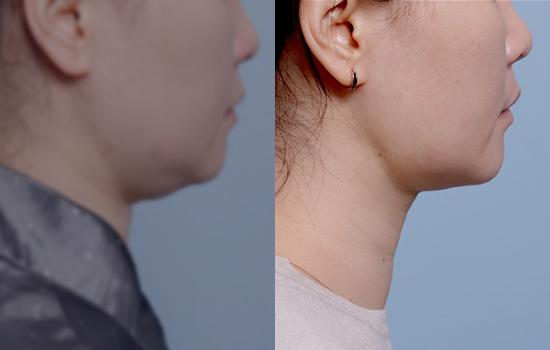 163cm/56.4kg/턱+벨로디/80cc/1개월