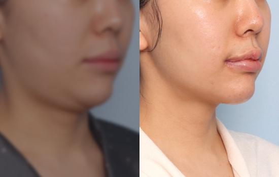 158cm/48kg/턱 지방흡입+벨로디2 /40cc/2개월