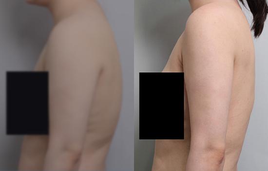 168cm/66kg/팔재+등지흡/2800cc/2개월
