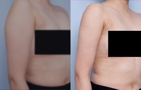 167cm/55.7kg/팔/1400cc/2개월