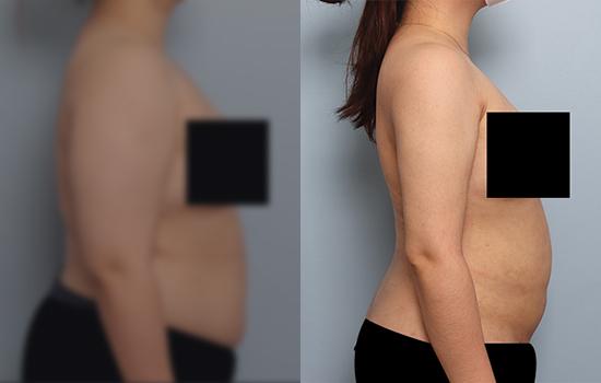 160cm/86kg/팔/3400cc/1개월