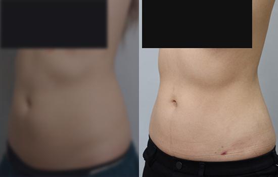 160cm/48.6kg/복부/1100cc/3개월 