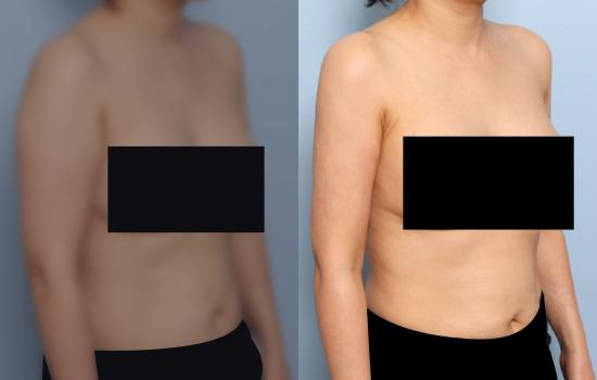 156cm/54.7kg/팔 지방흡입 /1500cc/1개월