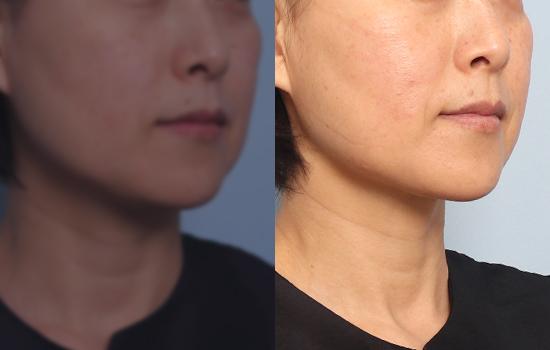 167cm/69kg/턱 지방흡입+벨로디2 /40cc/8개월