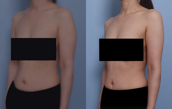 159cm/46.2kg/팔 지방흡입 /800cc/3개월