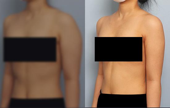 170cm/60kg/팔/1800cc/6개월