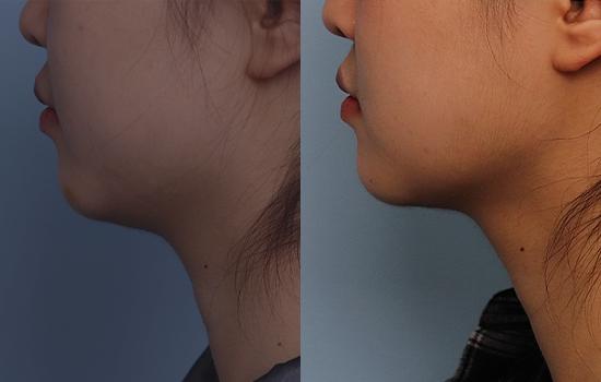 162cm/48.7kg/턱+벨로디2/50cc/6개월