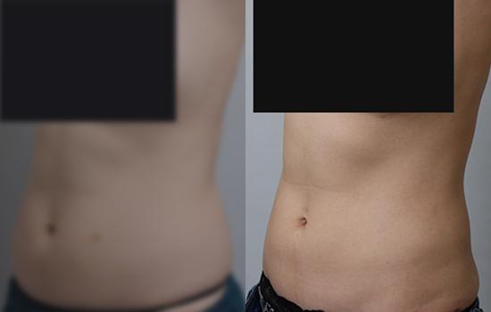 150cm/50.2kg/복부미니 옆구리/850cc/4개월 
