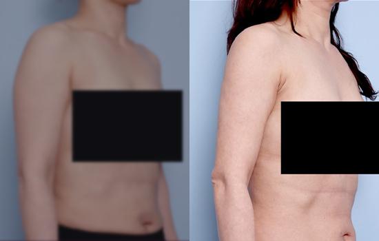 160cm/57.5kg/팔/1500cc/3개월