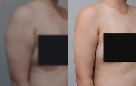 160cm/65.5kg/팔/1700cc/2개월