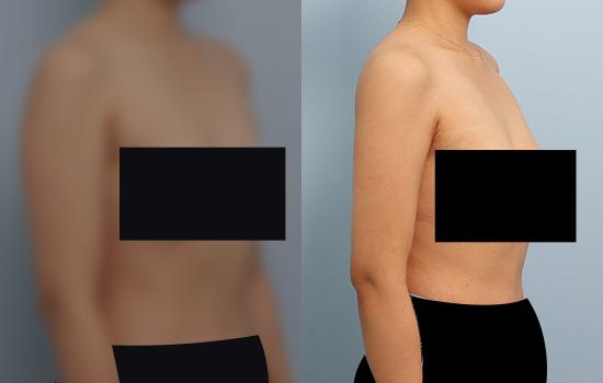 2개월 후/167cm/59kg/700cc