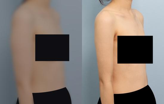 3개월 후/164cm/54kg/800cc