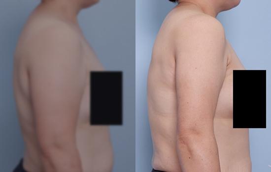 155cm/61.1kg/팔/2000cc/1개월