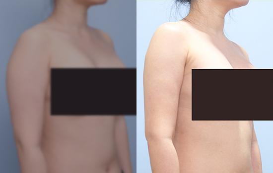 160cm/54.3kg/팔지흡+벨로디2/1200cc/15일후