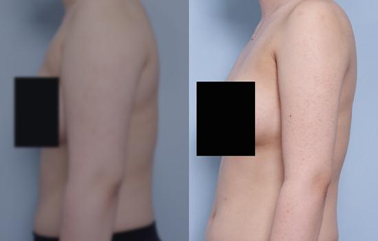 165cm/72.1kg/팔/2200cc/1개월