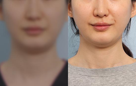 5개월 후/163cm/52kg/40cc