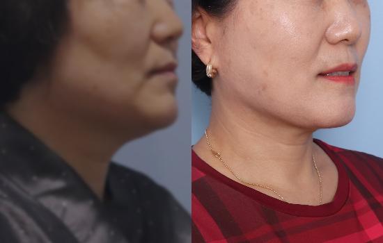 157cm/60kg/턱 지방흡입+벨로디2/60cc/5개월