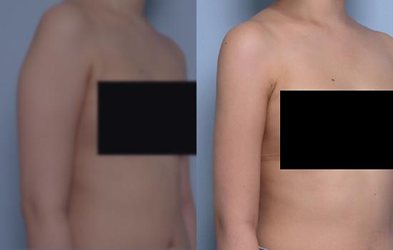 170cm/56.8kg/팔/1200cc/2개월