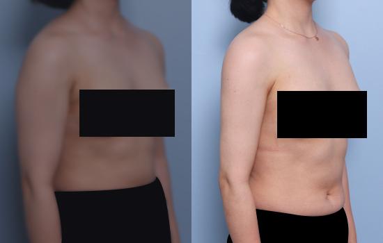 155cm/53.7kg/팔 지방흡입/1200cc/3개월