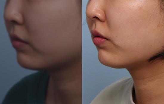 레인보우엣지