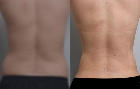 174cm/72.1kg/복부미니 옆구리/2500cc/4개월