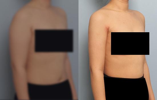 2개월 후/157cm/52kg/1800cc