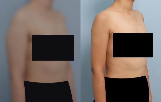 3개월 후/163cm/60kg/1000cc