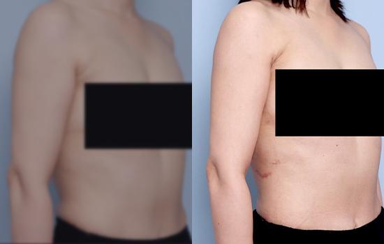 160cm/50kg/브라라인+부유방/900cc/3주후