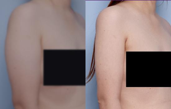 160cm/53.6kg/팔/1500cc/1개월