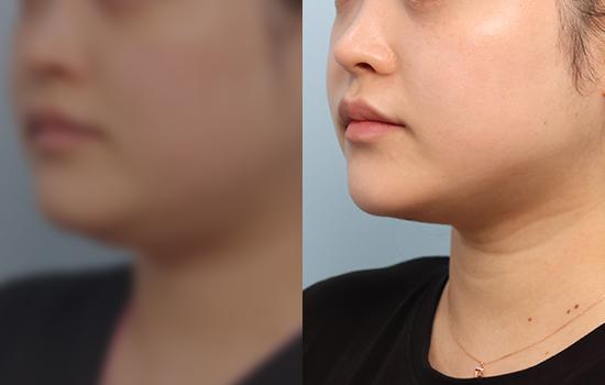 1개월 후/155cm/65kg/100cc