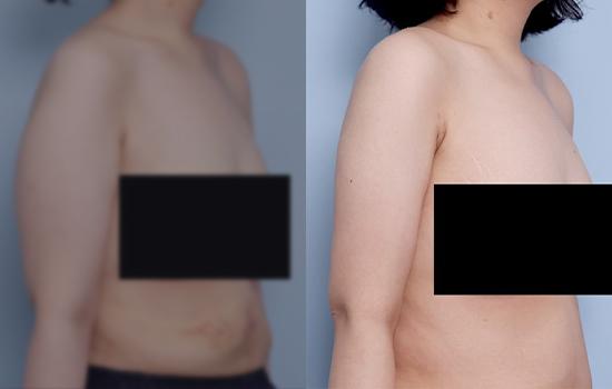 158cm/55.1kg/팔/1800cc/1개월