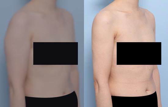 158cm/50.2kg/팔 지방흡입 /1000cc/2개월 