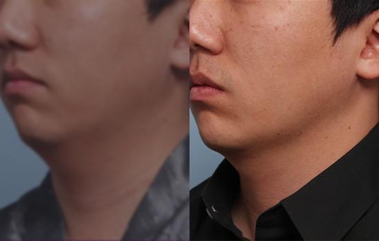 170cm/73kg/턱지흡/50cc/1개월
