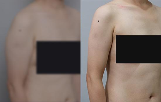 160cm/55.5kg/팔/900cc/3개월