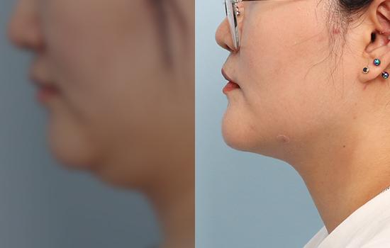 1개월 후/165cm/95kg/100cc