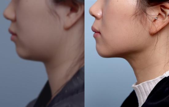 160cm/63kg/턱지흡+벨로디2/40cc/1개월
