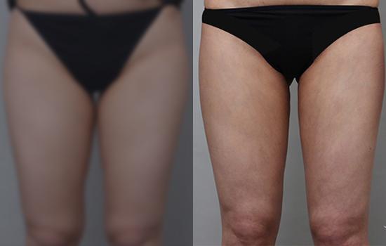 157cm/54kg/허벅지/700cc/13개월