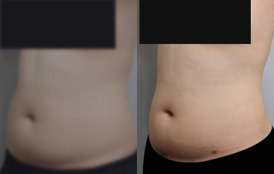 160cm/68.3kg/복부/2000cc/2개월