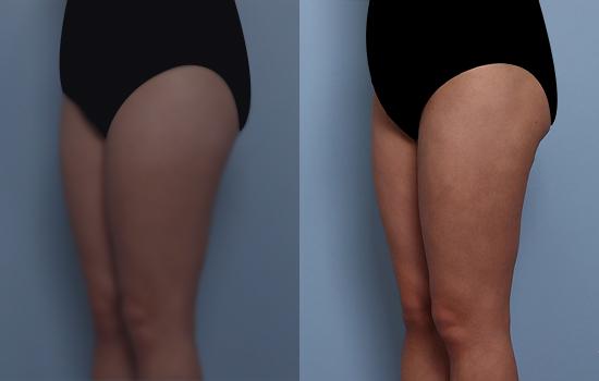 162cm/57.5kg/허벅지흡/2200cc/1개월