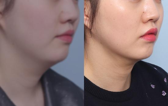 170cm/62kg/턱 지방흡입+벨로디2/85cc/1개월