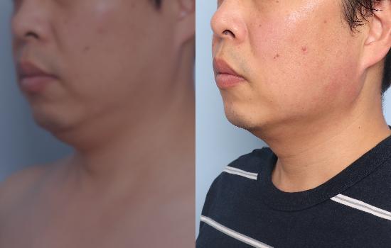 167cm/81kg/턱 지방흡입+벨로디2/55cc/29일