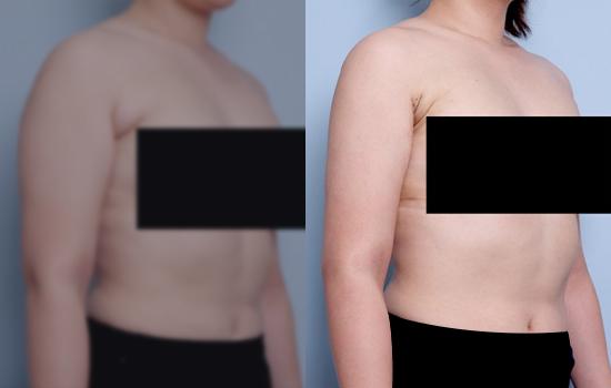 165.5cm/69.7kg/팔/2200cc/1개월