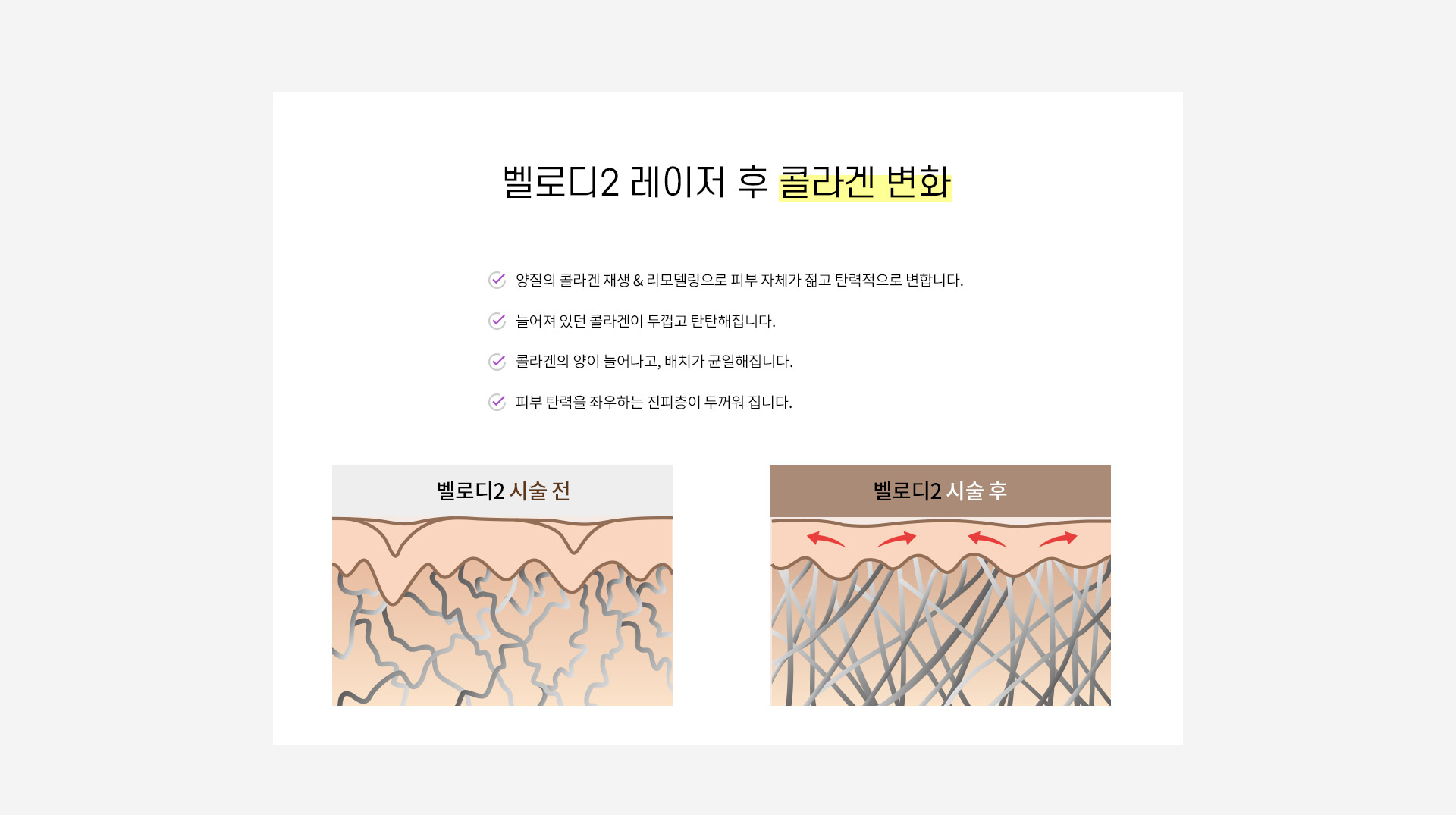 벨로디2 레이저 리프팅 시술 후 콜라겐의 변화