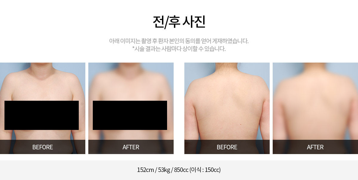 시술 전후사진