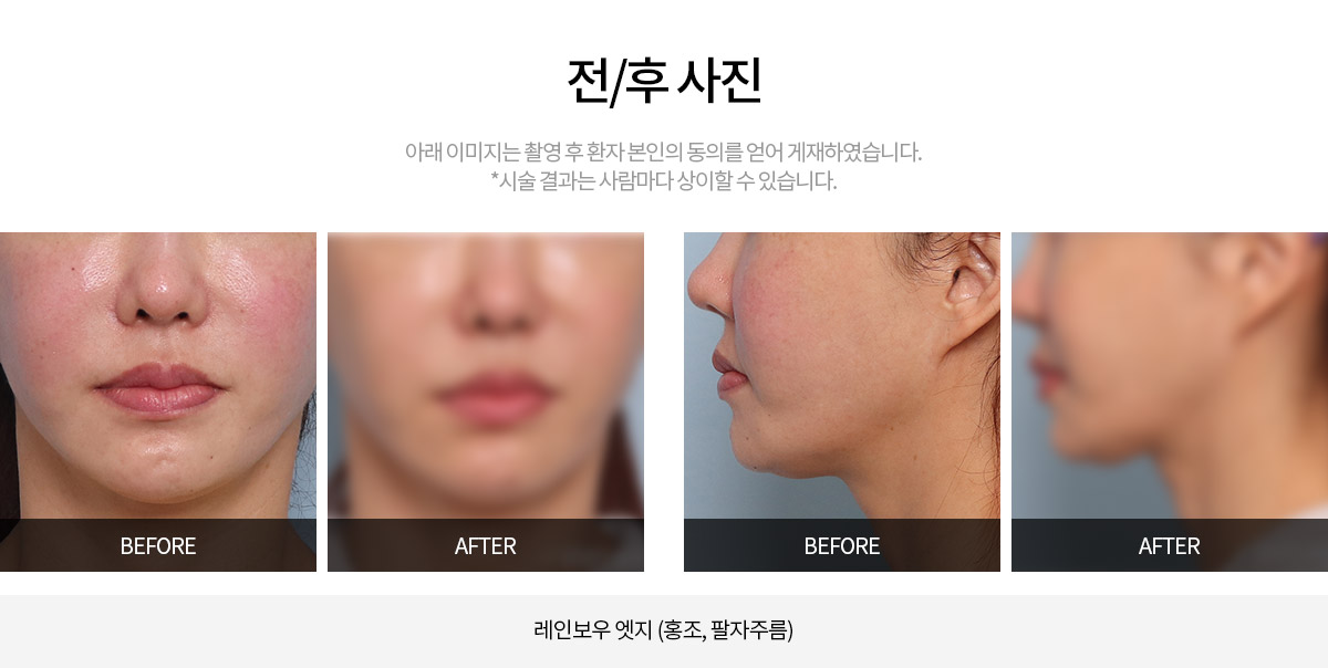 시술 전후사진