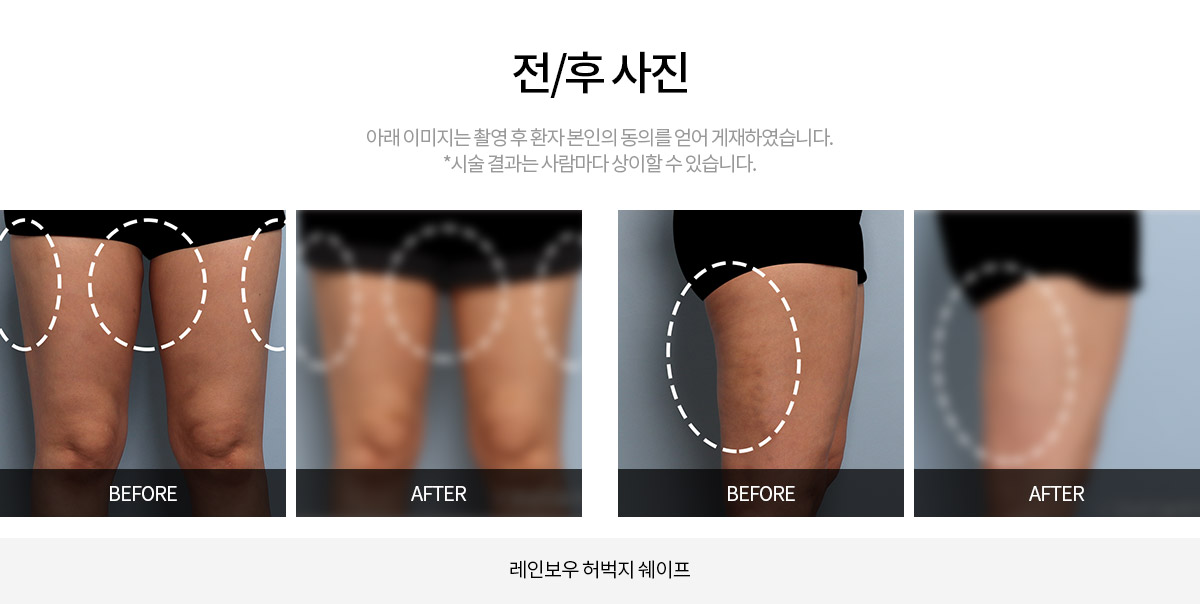 시술 전후사진