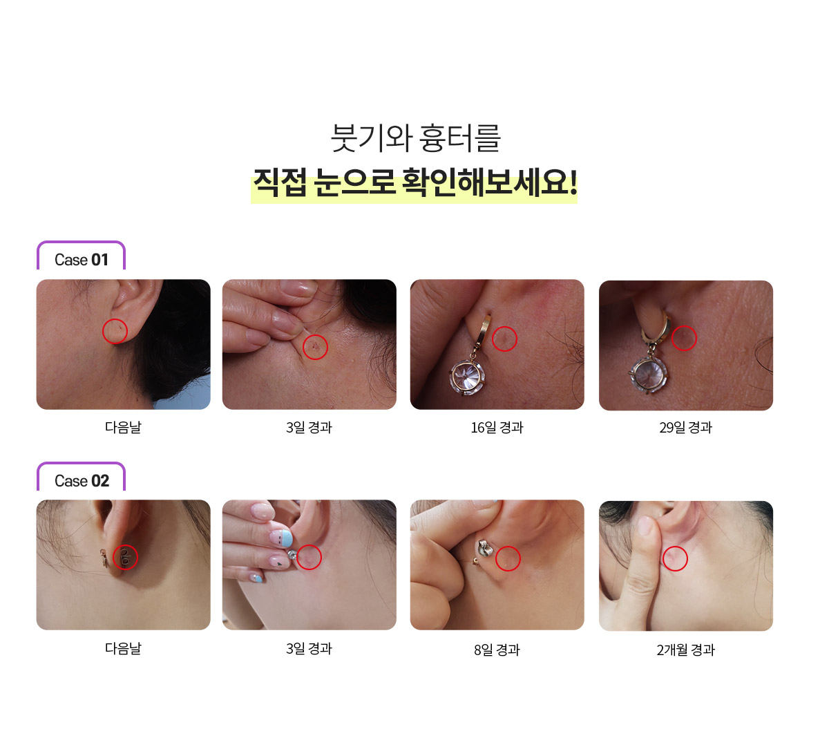 눈으로 확인하는 붓기와 흉터의 확연하고 확실한 회복