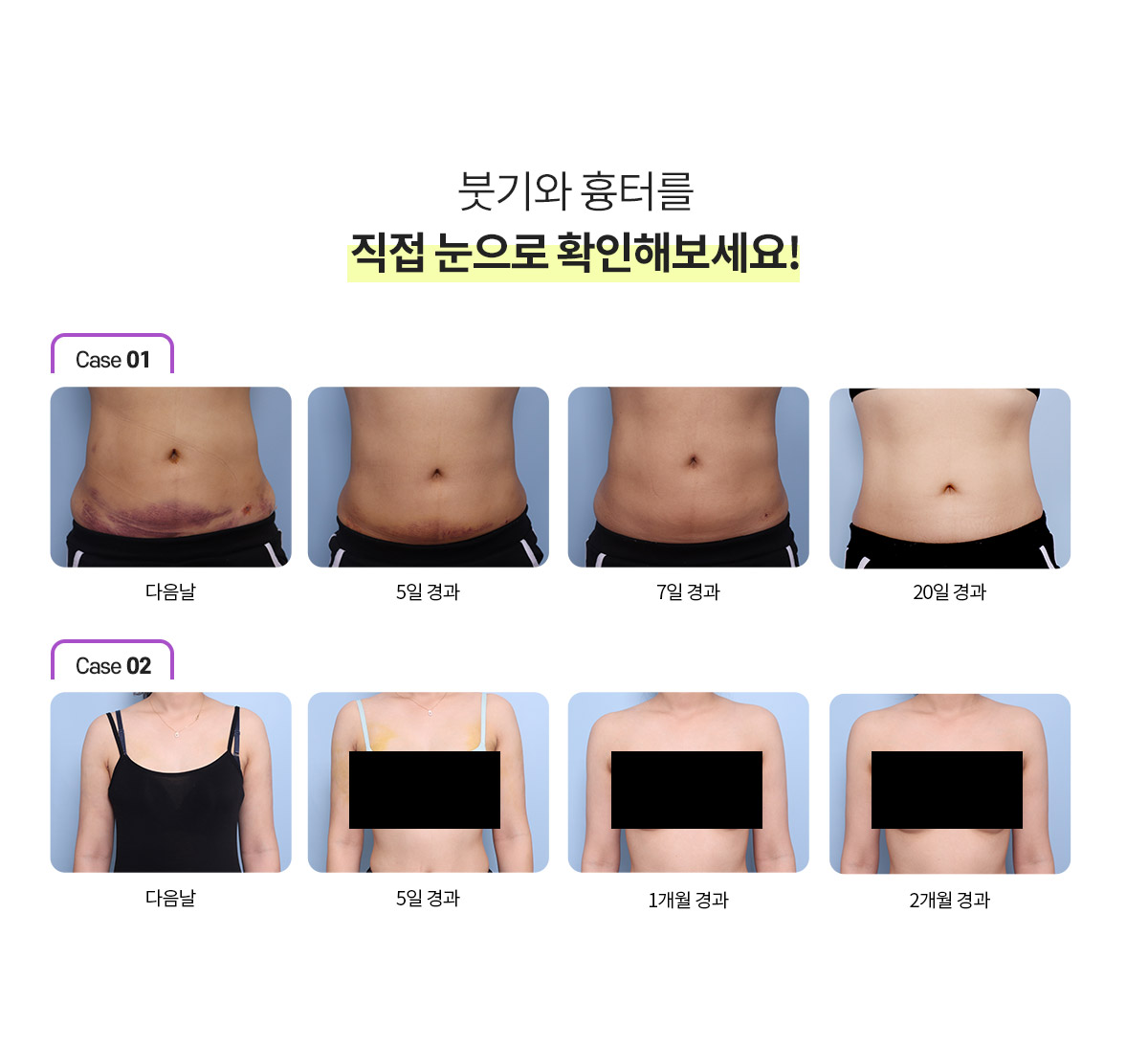 눈으로 확인하는 붓기와 흉터의 확연하고 확실한 회복