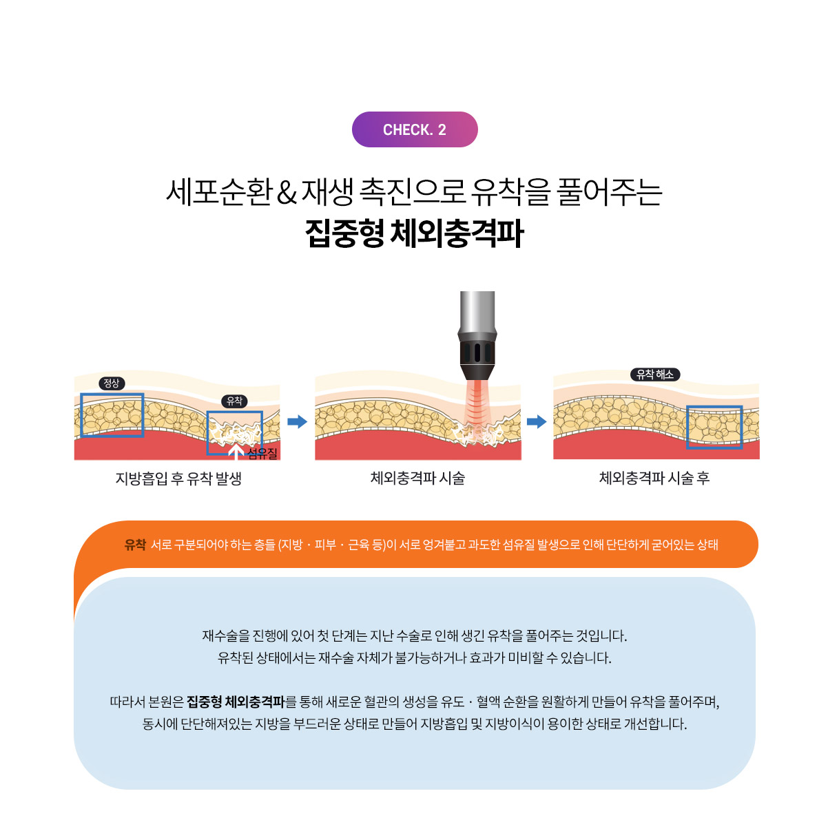 세포의 순환과 재생을 촉진해 유착을 풀어주는 ESWT 체외충격파